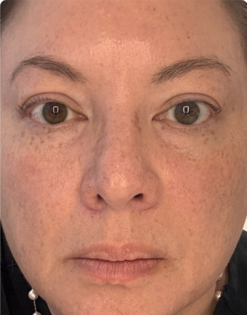 The same patient after a course of treatment, with the pigment much reduced