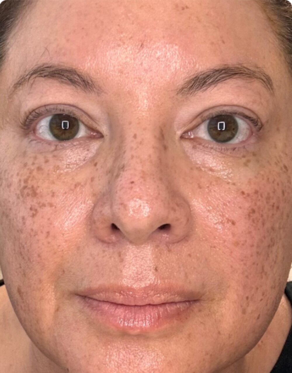 A patient's face before treatment, with pigment across the cheeks and nose